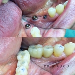 il dott. Francesco D'Auria è specializzato nelle riabilitazioni implantoprotesiche per tornare a sorridere e masticare come con i propri denti